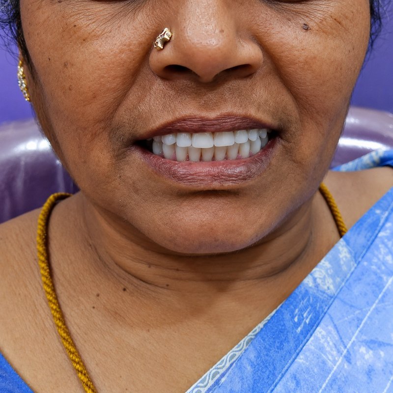 Patient smile after cosmetic dental restoration at Shanthi Dental Clinic