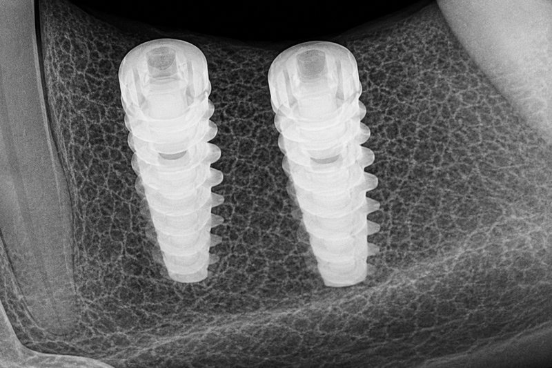 Dental implant X-ray scan at Shanthi Dental Clinic