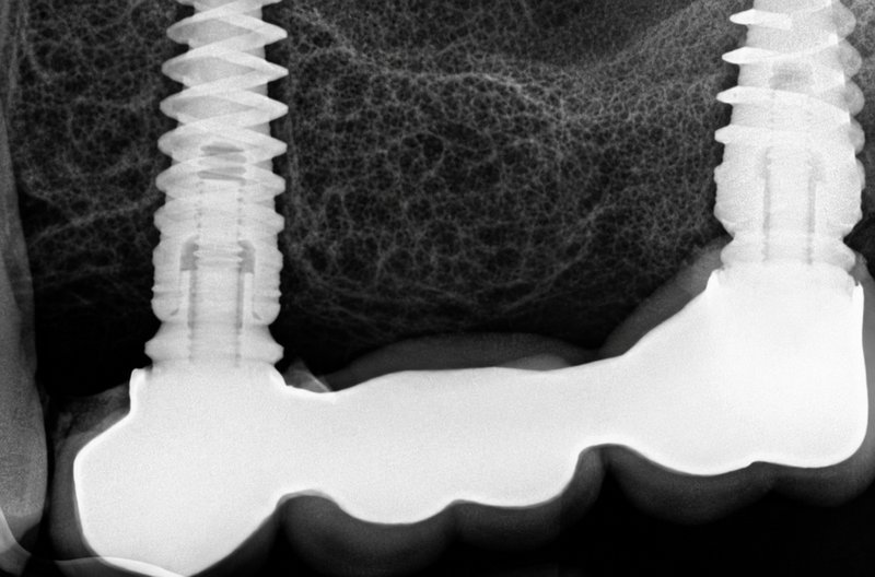Dental implant X-ray scan at Shanthi Dental Clinic