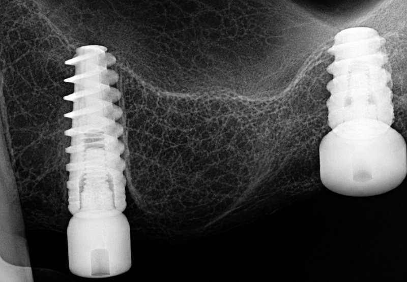 Dental implant X-ray scan at Shanthi Dental Clinic