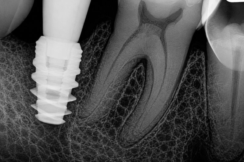 Dental implant and root canal X-ray scan at Shanthi Dental Clinic