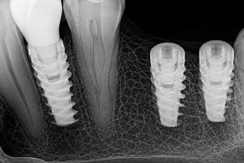Multiple dental implants X-ray scan at Shanthi Dental Clinic